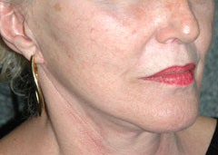 Revision Face Lift - Patient 1 - Obl Right - After Revision Face Lift - Patient 1 - Obl Right - After
